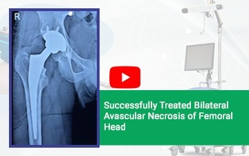 Successfully Treated Bilateral Avascular Necrosis of Femoral Head